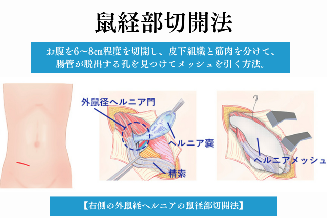 鼠径ヘルニアの治療